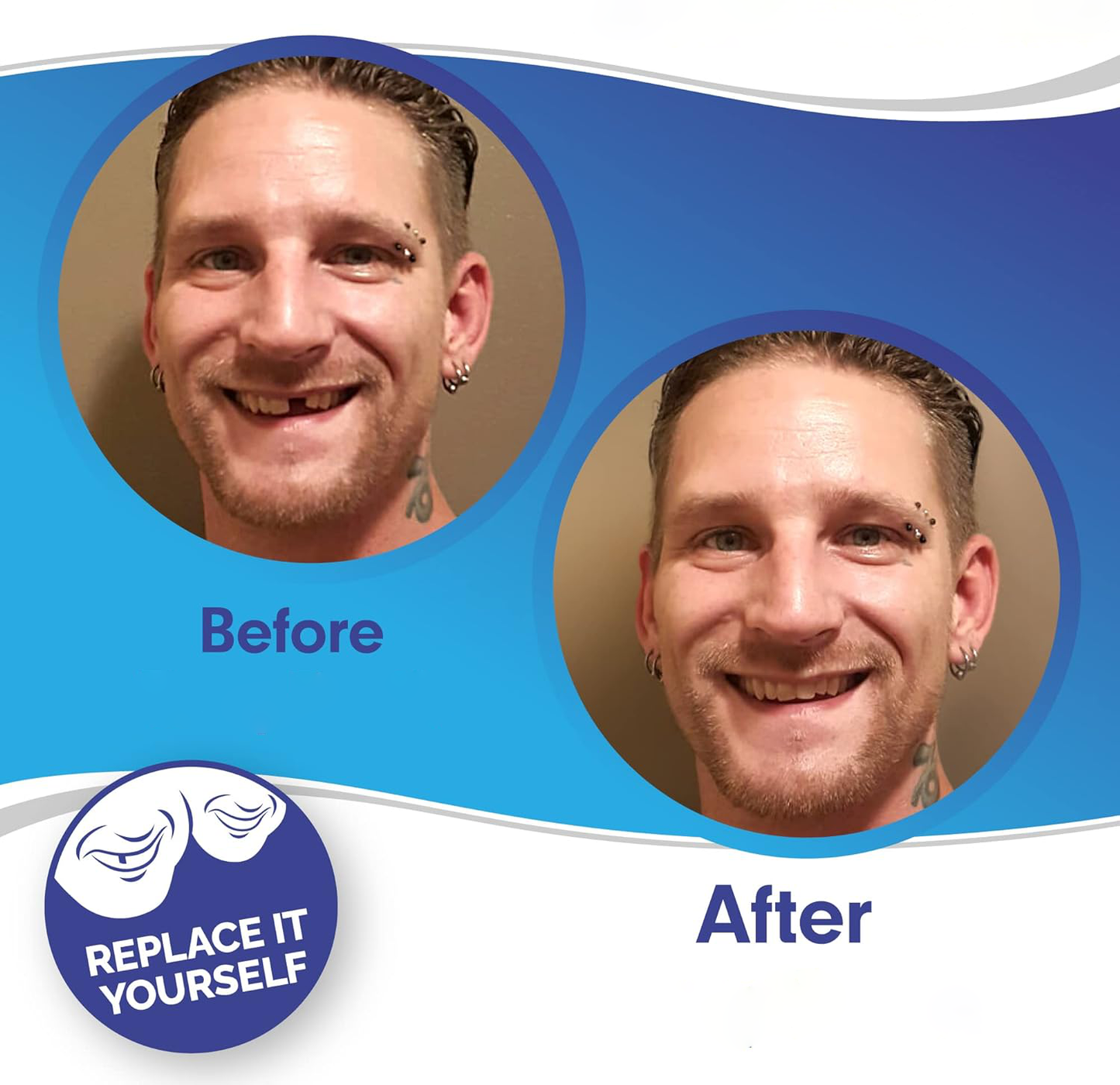 Smile Veneer (Upper & Lower Included)