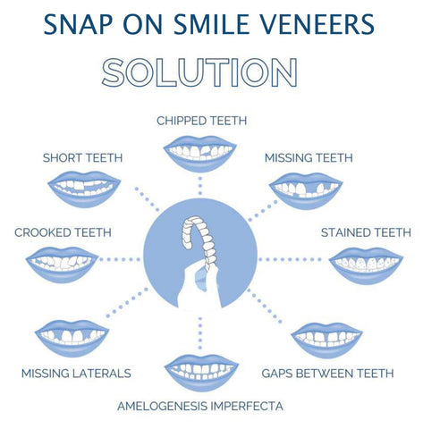 Smile Veneer (Upper & Lower Included)